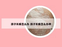 孩子长癣怎么办 孩子长癣怎么办啊