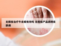 无限极治疗牛皮癣有效吗 无限极产品调理皮肤病