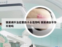 银屑病不治愈要孩子会遗传吗 银屑病会不孕不育吗