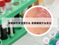 皮肤癣饮食注意什么 皮肤癣有什么忌口