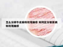 怎么分辨牛皮癣和玫瑰糠疹 如何区分银屑病和玫瑰糠疹