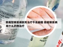 脓疱型银屑病割耳治疗牛皮癣图 脓疱银屑病用什么药物治疗