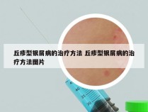 丘疹型银屑病的治疗方法 丘疹型银屑病的治疗方法图片