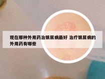 现在那种外用药治银屑病最好 治疗银屑病的外用药有哪些