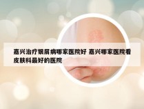 嘉兴治疗银屑病哪家医院好 嘉兴哪家医院看皮肤科最好的医院