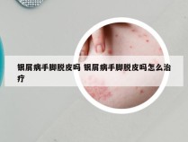 银屑病手脚脱皮吗 银屑病手脚脱皮吗怎么治疗