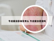 牛皮廨会影响生育么 牛皮廨会癌变吗