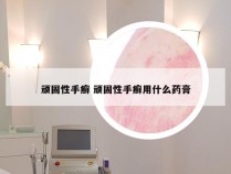 顽固性手癣 顽固性手癣用什么药膏