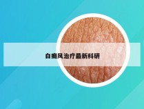 白癜风治疗最新科研