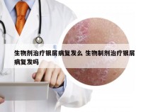 生物剂治疗银屑病复发么 生物制剂治疗银屑病复发吗