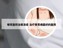 哪家医院治银消症 治疗银霄病最好的医院