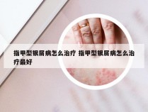 指甲型银屑病怎么治疗 指甲型银屑病怎么治疗最好