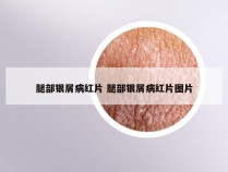 腿部银屑病红片 腿部银屑病红片图片