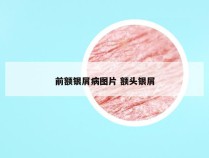 前额银屑病图片 额头银屑