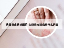 头藓类皮肤病图片 头藓类皮肤病用什么药膏