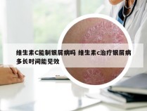 维生素C能制银屑病吗 维生素c治疗银屑病多长时间能见效