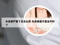 头皮癣严重了会怎么样 头皮癣是不是治不好了