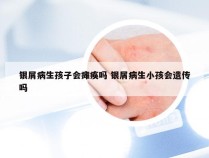 银屑病生孩子会瘫痪吗 银屑病生小孩会遗传吗