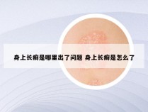 身上长癣是哪里出了问题 身上长癣是怎么了