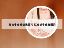 红皮牛皮癣症状图片 红皮病牛皮鲜图片