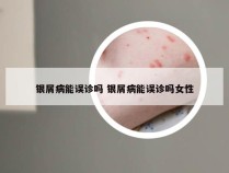 银屑病能误诊吗 银屑病能误诊吗女性