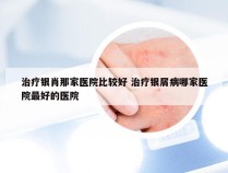 治疗银肖那家医院比较好 治疗银屑病哪家医院最好的医院