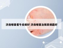 济南哪里看牛皮癣好 济南哪里治银屑病最好