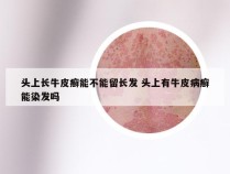 头上长牛皮癣能不能留长发 头上有牛皮病癣能染发吗