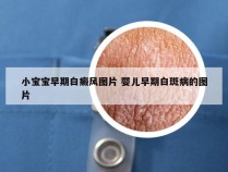 小宝宝早期白癜风图片 婴儿早期白斑病的图片