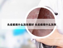 头皮癣用什么洗效果好 头皮癣用什么洗剂