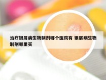 治疗银屑病生物制剂哪个医院有 银屑病生物制剂哪里买