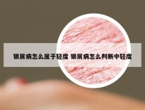 银屑病怎么属于轻度 银屑病怎么判断中轻度