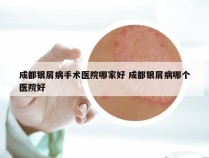 成都银屑病手术医院哪家好 成都银屑病哪个医院好