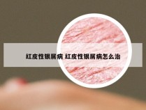 红皮性银屑病 红皮性银屑病怎么治