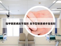 指甲银屑病关节变形 关节型银屑病手指变形