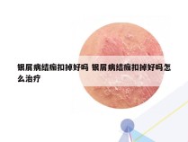 银屑病结痂扣掉好吗 银屑病结痂扣掉好吗怎么治疗