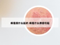 癣是因什么起的 癣是什么原因引起