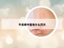 牛皮癣中医有什么药方