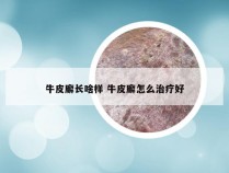 牛皮廨长啥样 牛皮廨怎么治疗好