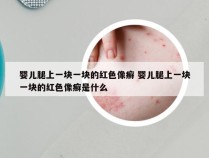 婴儿腿上一块一块的红色像癣 婴儿腿上一块一块的红色像癣是什么