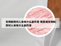 生物制剂对人体有什么副作用 银屑病生物制剂对人体有什么副作用