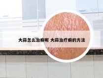 大蒜怎么治癣呢 大蒜治疗癣的方法