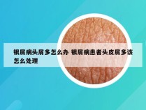 银屑病头屑多怎么办 银屑病患者头皮屑多该怎么处理