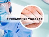 牛皮屑怎么控制不蔓延 牛皮屑怎么去除