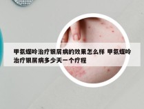 甲氨蝶呤治疗银屑病的效果怎么样 甲氨蝶呤治疗银屑病多少天一个疗程