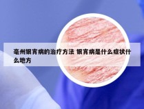 毫州银宵病的治疗方法 银宵病是什么症状什么地方