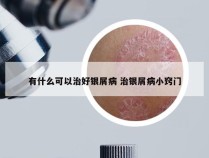 有什么可以治好银屑病 治银屑病小窍门