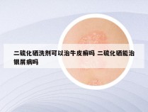 二硫化硒洗剂可以治牛皮癣吗 二硫化硒能治银屑病吗