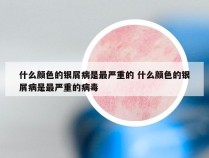 什么颜色的银屑病是最严重的 什么颜色的银屑病是最严重的病毒