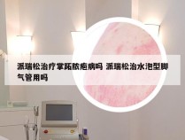 派瑞松治疗掌跖脓疱病吗 派瑞松治水泡型脚气管用吗